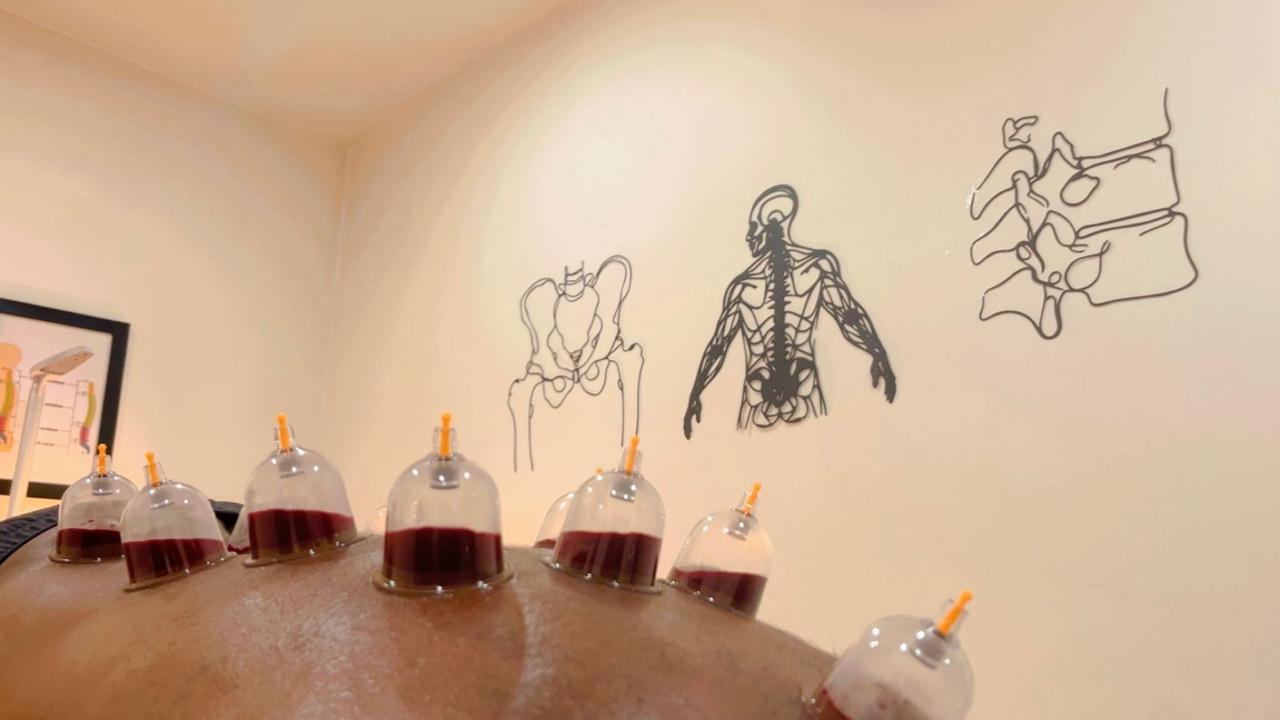 Cupping (Hijama) Therapy