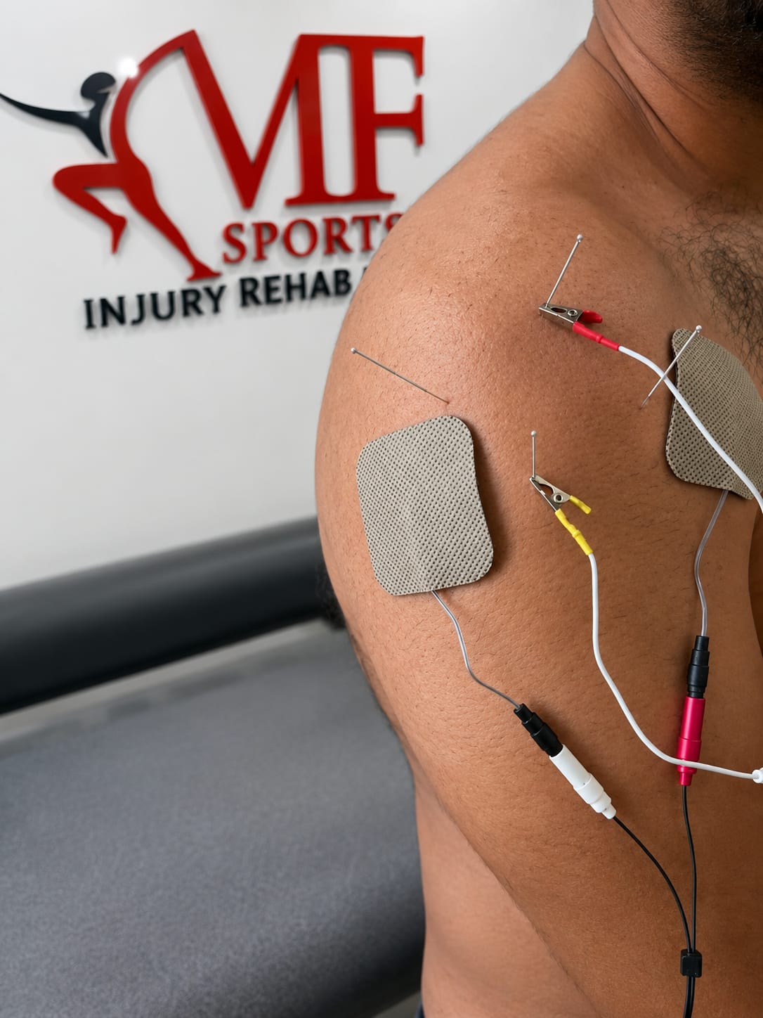 Electro Acupuncture