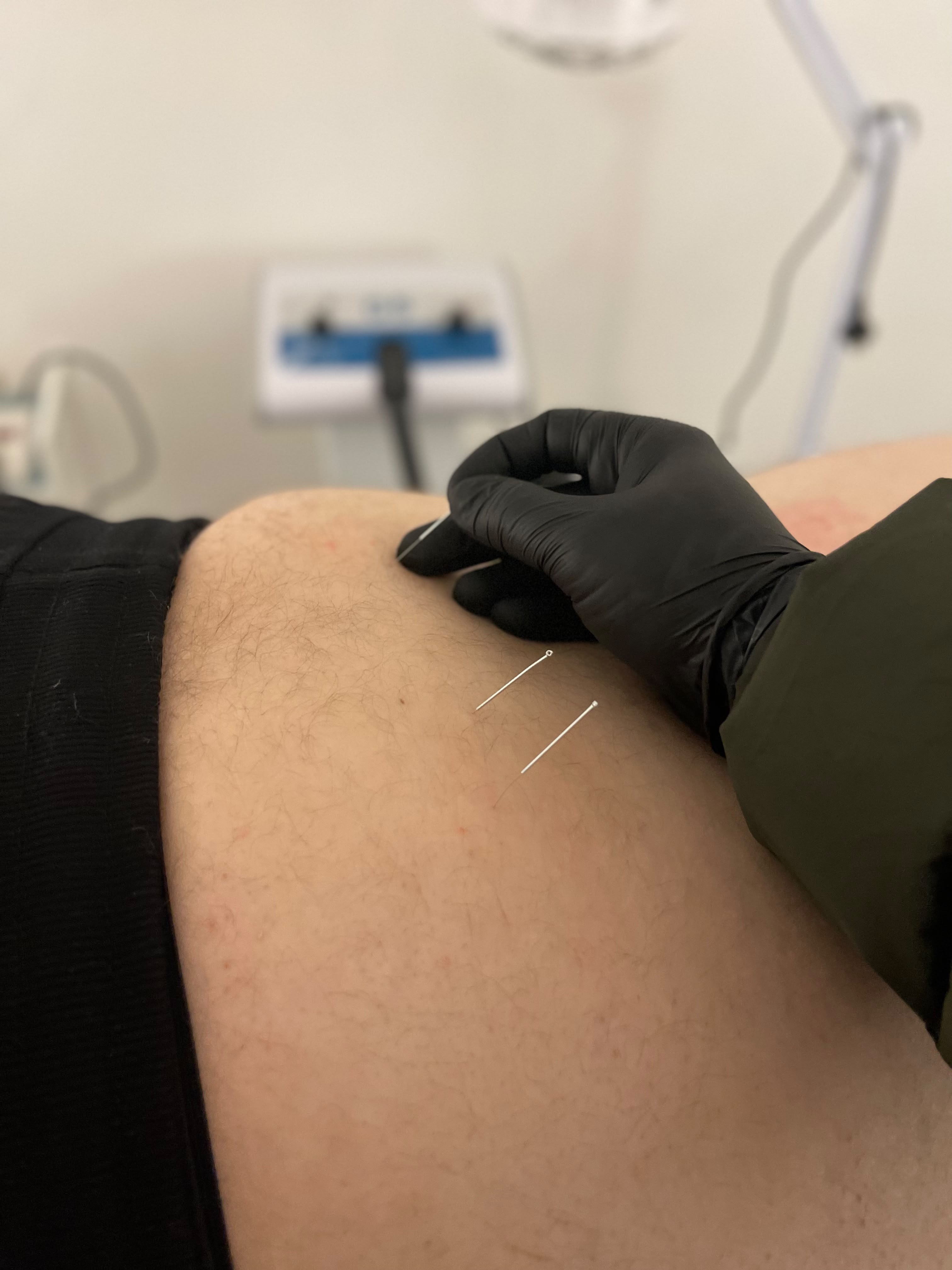 Dry Needling